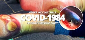 COVID-1984 vacc1n can produce grievous sores - proof
