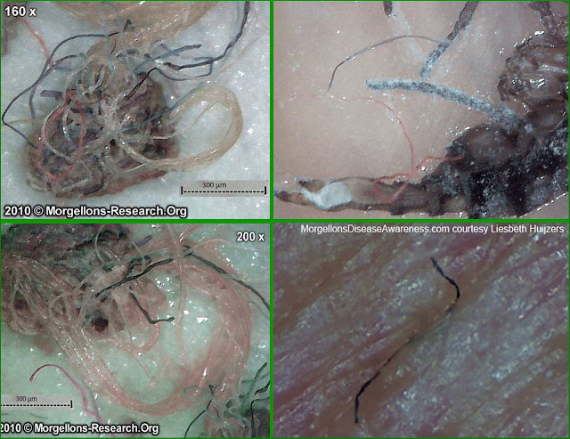 morgellons coming out of the skin due to chemtrails - living organisms