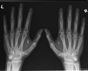 RFID chip in both hands