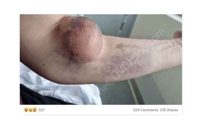 British man - post-AstraZeneca, shows baseball-sized blood clot in his arm