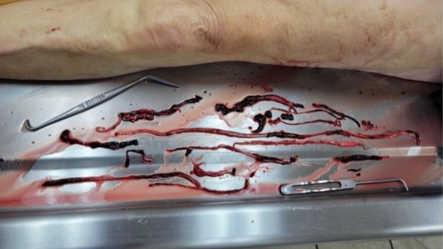Embalmers Find Veins and Arteries Filled with Never Before Seen Rubbery Clots