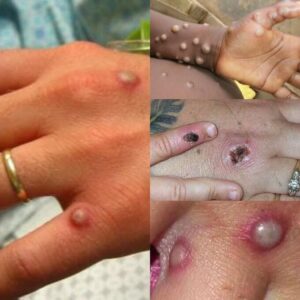 Monkey pox in Belgium, Europe - Apenpokkenvirus