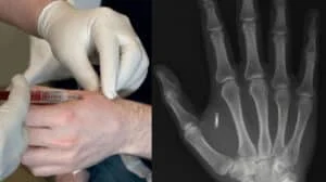 RFID chip implant microchip Mark of the Beast 666