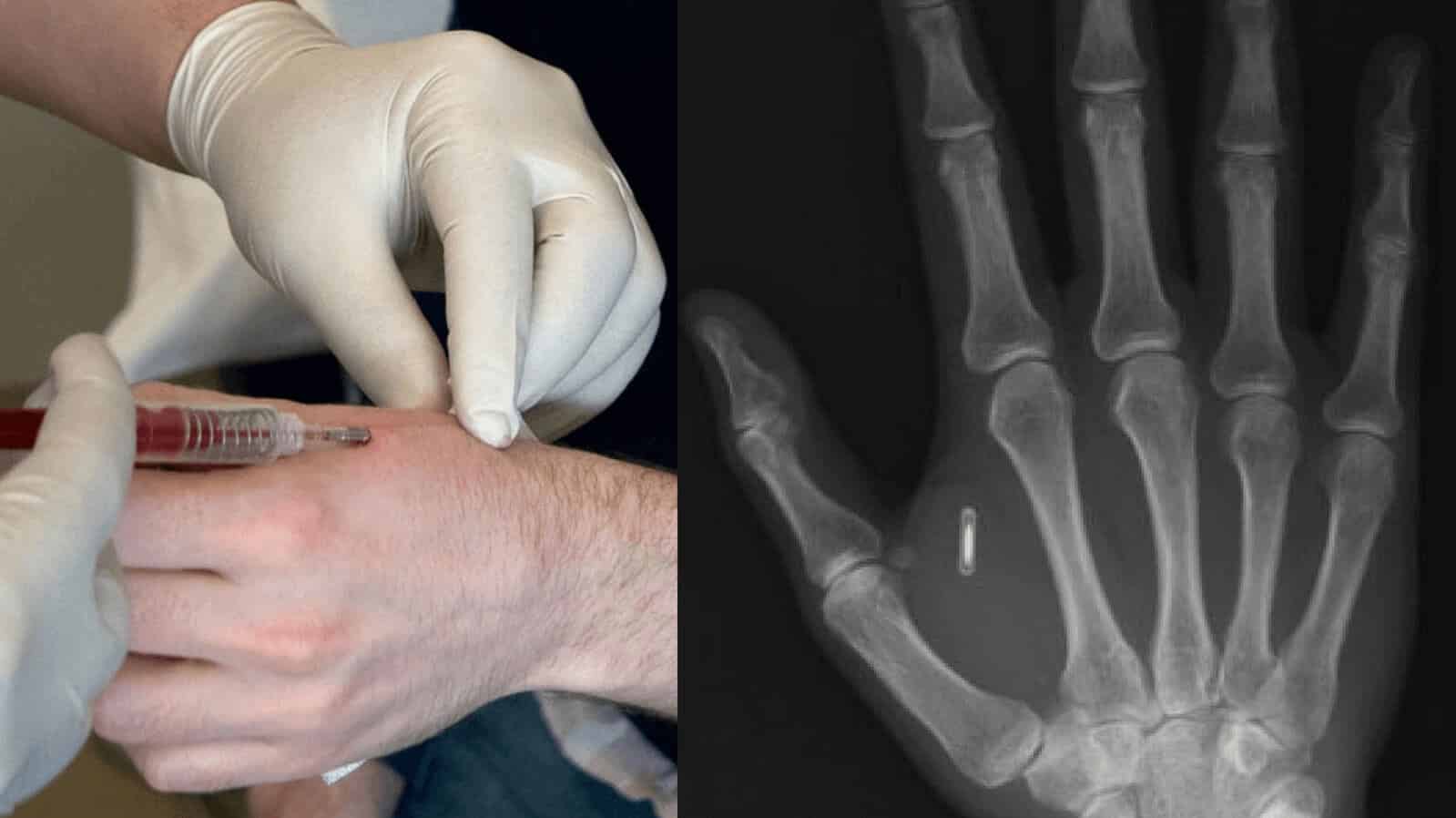RFID chip implant microchip Mark of the Beast 666