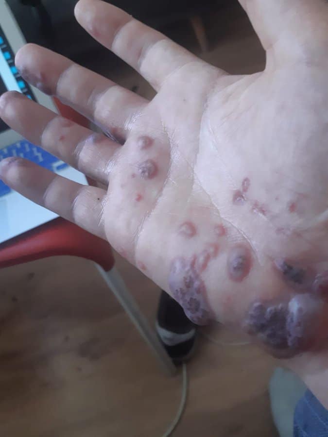 sores on hand - Is it really monkey pox